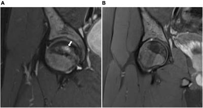 Complete resolution of stage II avascular necrosis affecting three joints by hyperbaric oxygen in a patient with sickle cell disease: A case report